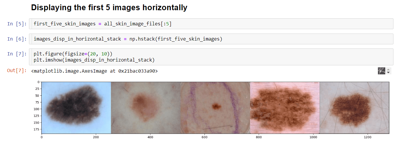 Skin Lesion Segmentation using OpenCV